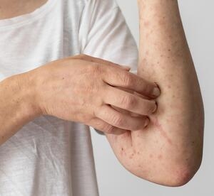 ¿Viruela símica o Monkeypox, qué tan grave es?